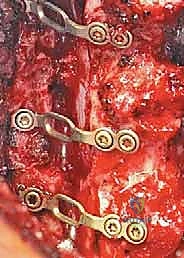 صورة توضيحية لـ رأب الصفيحة العنقية في صنعاء دليل شامل لفك ضغط العمود الفقري واستعادة الحركة مع الأستاذ الدكتور محمد هطيف