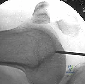 Illustration of retrograde femoral nailing - Dr. Mohammed Hutaif
