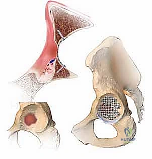 تحضير العظم المضيف وتنظيف التجويف الحقي
