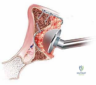 وضع الأسمنت العظمي فوق الطعم المدكوك لتثبيت الكوب الجديد
