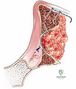 استخدام الأدوات الخاصة لدك ورص الطعم العظمي داخل الحُق