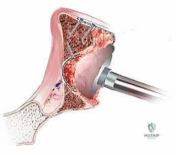 زرع الطعم العظمي المدكوك للحُق: حل متقدم لفقدان عظم الورك في جراحات مراجعة مفصل الورك الكلي