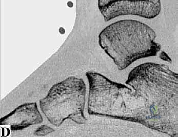 صورة توضيحية لـ تنظير الكاحل الخلفي والمنظار الجراحي للقدم الخلفية: حلول متقدمة لآلام الكاحل المعقدة في صنعاء مع الأستاذ الدكتور محمد هطيف