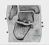 التهاب الأوتار في الكاحل