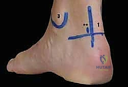 المداخل الجراحية الدقيقة