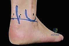 صورة طبية: تنظير الكاحل الخلفي والمنظار الجراحي للقدم الخلفية: حلول متقدمة لآلام الكاحل المعقدة في صنعاء مع الأستاذ الدكتور محمد هطيف