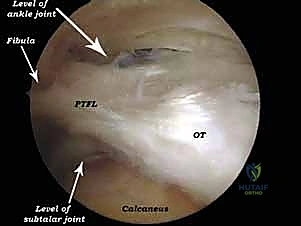 الأجسام الحرة داخل المفصل