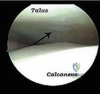 صورة طبية: تنظير الكاحل الخلفي والمنظار الجراحي للقدم الخلفية: حلول متقدمة لآلام الكاحل المعقدة في صنعاء مع الأستاذ الدكتور محمد هطيف