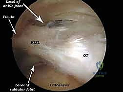 الأوتار والأربطة في القدم الخلفية