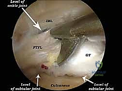 صورة توضيحية لـ تنظير الكاحل الخلفي والمنظار الجراحي للقدم الخلفية: حلول متقدمة لآلام الكاحل المعقدة في صنعاء مع الأستاذ الدكتور محمد هطيف