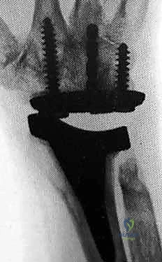 Illustration of total wrist arthroplasty - Dr. Mohammed Hutaif