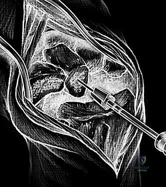 Lower Back Pain and Disorders of Intervertebral Discs: A Comprehensive Surgical Guide