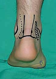 Endoscopic Resection of Posterior Ankle Impingement: An Intraoperative Masterclass