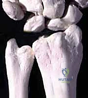 Illustration of distal ulna resection - Dr. Mohammed Hutaif