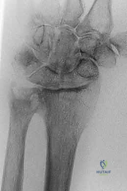 Illustration of disorders of the distal - Dr. Mohammed Hutaif