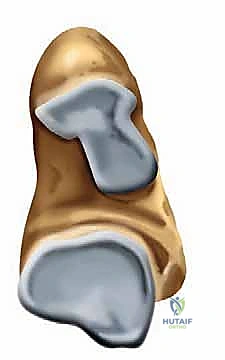 علاج خشونة مفصل تحت الكاحل بالمنظار