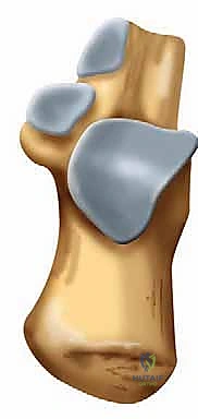 إزالة القطع الحرة والالتصاقات بالمنظار