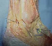 صورة توضيحية لـ منظار مفصل تحت الكاحل: حل شامل لآلام مؤخرة القدم مع الأستاذ الدكتور محمد هطيف