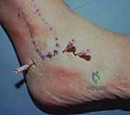 صورة توضيحية لـ منظار مفصل تحت الكاحل: حل شامل لآلام مؤخرة القدم مع الأستاذ الدكتور محمد هطيف