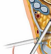 استخدام الحقن التشخيصي لتحديد مصدر الألم