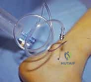 منظار مفصل تحت الكاحل: حل شامل لآلام مؤخرة القدم مع الأستاذ الدكتور محمد هطيف