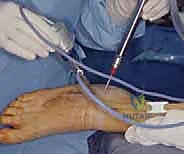 تقنيات متقدمة في منظار مفصل تحت الكاحل