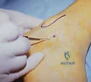 العودة للنشاط الطبيعي والرياضي