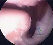 صورة توضيحية لـ منظار مفصل تحت الكاحل: حل شامل لآلام مؤخرة القدم مع الأستاذ الدكتور محمد هطيف