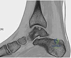 صورة شعاعية تظهر آفة في الكاحل