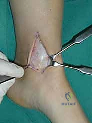 مراحل تطور الآفات الغضروفية