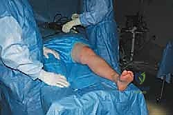 تصوير بالرنين المغناطيسي يوضح حجم التلف الغضروفي