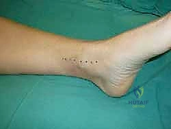 أدوات الجراحة الميكروسكوبية والمناظير