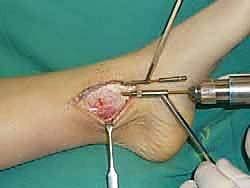 استخدام الحذاء الطبي الداعم