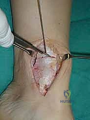 مقارنة بين الغضروف الليفي والزجاجي