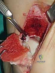 صورة توضيحية لـ علاج آفات القبة الكاحلية العظمية الغضروفية بالزرع الذاتي: خبرة الأستاذ الدكتور محمد هطيف في صنعاء