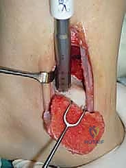 صورة توضيحية لـ علاج آفات القبة الكاحلية العظمية الغضروفية بالزرع الذاتي: خبرة الأستاذ الدكتور محمد هطيف في صنعاء