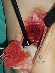 صورة توضيحية لـ علاج آفات القبة الكاحلية العظمية الغضروفية بالزرع الذاتي: خبرة الأستاذ الدكتور محمد هطيف في صنعاء