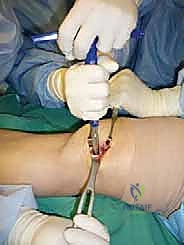 صورة طبية: علاج آفات القبة الكاحلية العظمية الغضروفية بالزرع الذاتي: خبرة الأستاذ الدكتور محمد هطيف في صنعاء