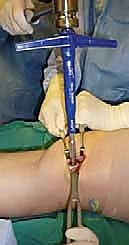 صورة طبية: علاج آفات القبة الكاحلية العظمية الغضروفية بالزرع الذاتي: خبرة الأستاذ الدكتور محمد هطيف في صنعاء