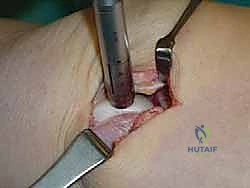 صورة طبية: علاج آفات القبة الكاحلية العظمية الغضروفية بالزرع الذاتي: خبرة الأستاذ الدكتور محمد هطيف في صنعاء