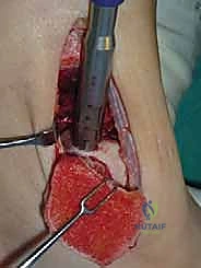 صورة طبية: علاج آفات القبة الكاحلية العظمية الغضروفية بالزرع الذاتي: خبرة الأستاذ الدكتور محمد هطيف في صنعاء