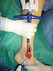 صورة طبية: علاج آفات القبة الكاحلية العظمية الغضروفية بالزرع الذاتي: خبرة الأستاذ الدكتور محمد هطيف في صنعاء