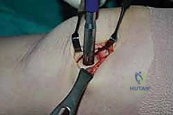 صورة طبية: علاج آفات القبة الكاحلية العظمية الغضروفية بالزرع الذاتي: خبرة الأستاذ الدكتور محمد هطيف في صنعاء