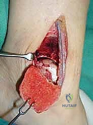 صورة طبية: علاج آفات القبة الكاحلية العظمية الغضروفية بالزرع الذاتي: خبرة الأستاذ الدكتور محمد هطيف في صنعاء