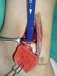 صورة طبية: علاج آفات القبة الكاحلية العظمية الغضروفية بالزرع الذاتي: خبرة الأستاذ الدكتور محمد هطيف في صنعاء