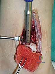 صورة طبية: علاج آفات القبة الكاحلية العظمية الغضروفية بالزرع الذاتي: خبرة الأستاذ الدكتور محمد هطيف في صنعاء