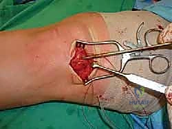 صورة طبية: علاج آفات القبة الكاحلية العظمية الغضروفية بالزرع الذاتي: خبرة الأستاذ الدكتور محمد هطيف في صنعاء