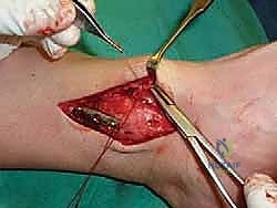 صورة طبية: علاج آفات القبة الكاحلية العظمية الغضروفية بالزرع الذاتي: خبرة الأستاذ الدكتور محمد هطيف في صنعاء