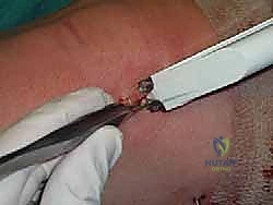 صورة طبية: علاج آفات القبة الكاحلية العظمية الغضروفية بالزرع الذاتي: خبرة الأستاذ الدكتور محمد هطيف في صنعاء