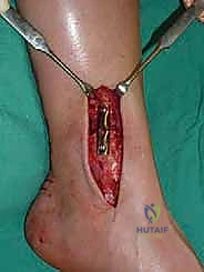 صورة طبية: علاج آفات القبة الكاحلية العظمية الغضروفية بالزرع الذاتي: خبرة الأستاذ الدكتور محمد هطيف في صنعاء